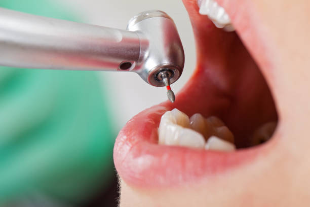 Best Emergency Dentist for Lost Fillings or Crowns in Fort Myers Shores, FL
